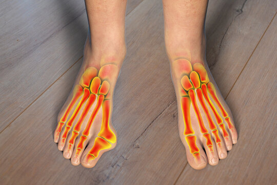Toe deformation, also known as hallux valgus, or bunion