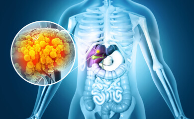 Liver damage such as Fatty liver, Fibrosis, Cirrhosis, and Liver cancer. 3d illustration - obrazy, fototapety, plakaty