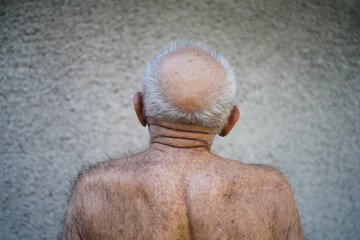 An old man has a bald head. The problem of male pattern baldness
