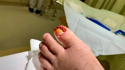 male patient with ingrown toe nail waiting for an operation. Background Blurred