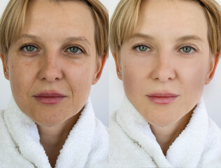 Woman face wrinkles before and after treatment