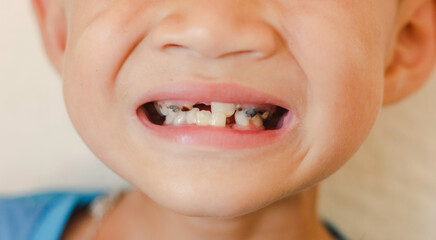 young  boy smile with a dental, Tooth dental close up caries extensive early dental caries, dentist...