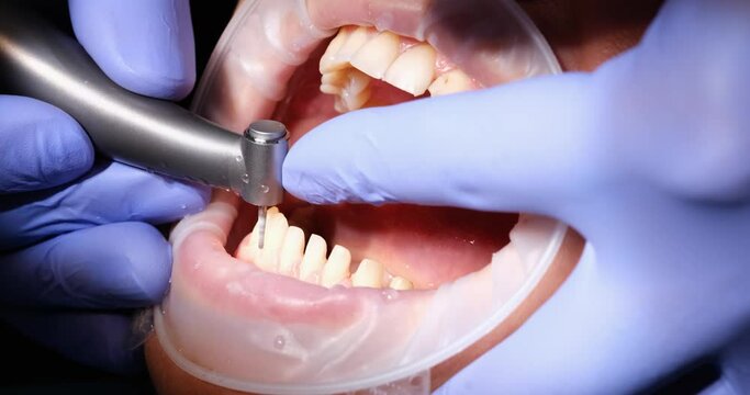 Dentist prepares female teeth and removes tooth enamel for installation of ceramic veneers and crowns using drill