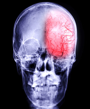 Cerebral angiography