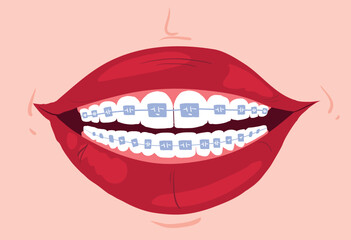 Wide female smile with braces with red lips. Clean teeth with mouthwash in flat design. Smiling teeth cartoon dental care. Oral healthcare with mouthwash for plaque prevention and fresh breath.