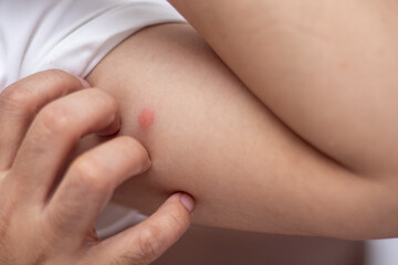 scratching the red blister area