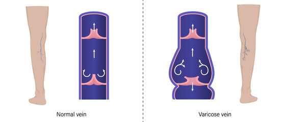 Comparison between normal veins and varicose veins in cross-sectional form. Vector for use in scientific study and medical treatment.