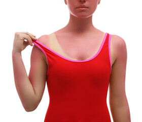 Woman with sunburned skin on white background, closeup