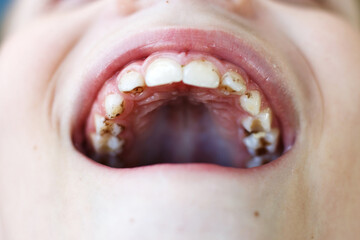 Obraz premium open mouth of a child boy with plaque or calculus on the teeth close. oral hygiene concept