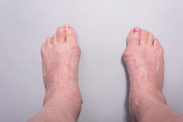 close-up of big toe disease curvature in elderly woman on gray background