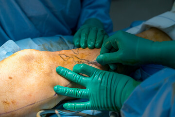Process of varicose vein surgery in hospital, operating room, vein sealing, venous vascular surgery...
