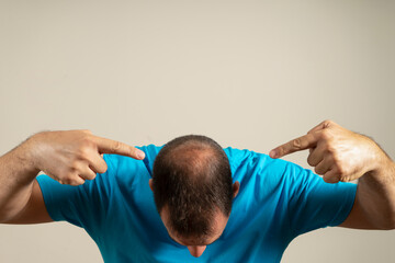 Human alopecia or hair loss. Middle-aged Latino man pointing to his head highlighting his incipient alopecia