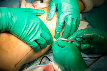 Process of varicose vein surgery in hospital, operating room, vein sealing, venous vascular surgery...