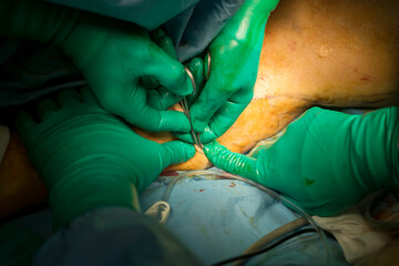 Process of varicose vein surgery in hospital, operating room, vein sealing, venous vascular surgery concept