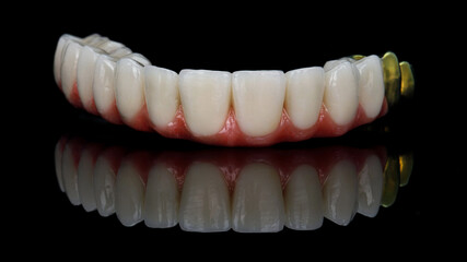 hybrid dental prosthesis of the upper jaw on a black background with creative reflection © Dental Pro Content