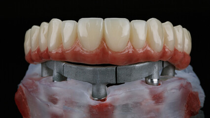 excellent dental prosthesis with the gums of the upper jaw with a bar from different parts on a black background © Dental Pro Content