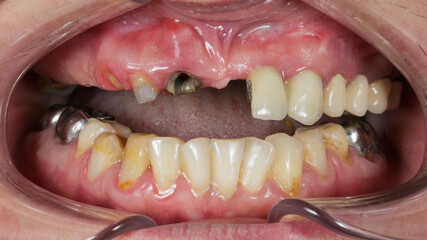 patient's edentulous upper jaw © Dental Pro Content