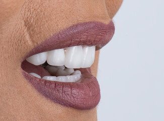 Obraz premium dental job photography, crowns veneers implants