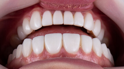 dental job photography, crowns veneers implants