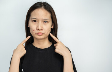 Young Asian woman pointing to acne problems on her face.