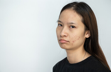 Worried Asian woman caused of acne inflammation on her face.