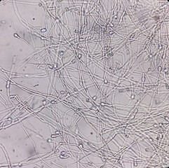 Photomicrograph showing Hyphae of dermatophytes, Nail scraping or skin scraping for fungus test in...