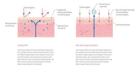 Infographic of healthy skin and skin with atopic dermatitis, how external factors and hydration affect the skin.