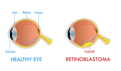 Retinoblastoma illustration diagram, anatomical scheme. Comparison between healthy eye and damaged eye