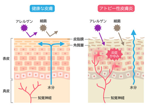 アトピー性皮膚炎と健康な皮膚　肌細胞と断面図