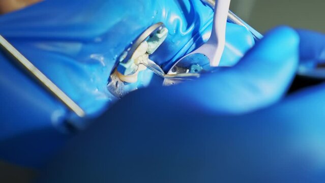 Close up footage of dentist working tooth filling in clinic.