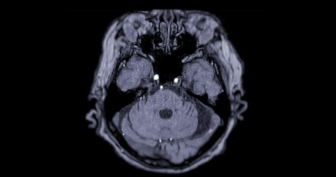 MRA Brain or Magnetic resonance angiography of the brain AXIAL  view showing cerebral artery .