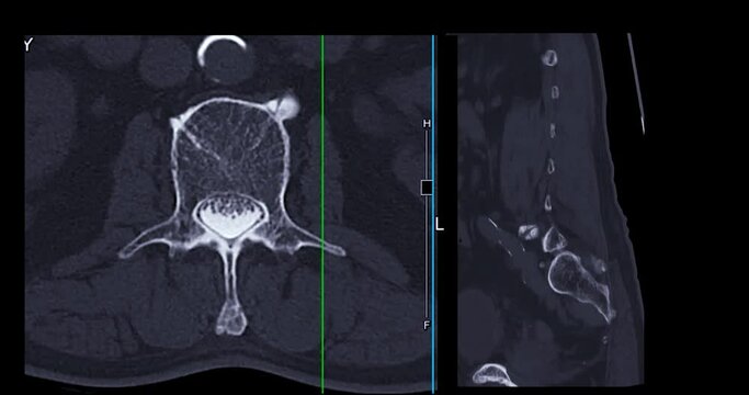CT myelography or myelogram from computed tomography (CT-scanner) to look for problems in the spinal canal.