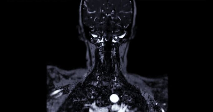 MRA corotid artery technique Time-of-Flight (TOF) showing common carotid artery.
