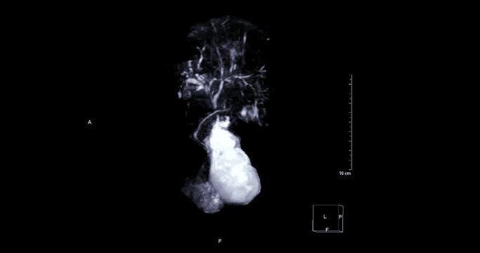 Magnetic resonance cholangiopancreatography or MRCP 3D  MIP view showing visualize the biliary and pancreatic ducts .