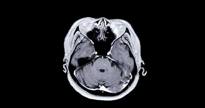 MRI of the brain Axial T1 FS technique after injection gadolinium contrast showing anatomical of the brain .