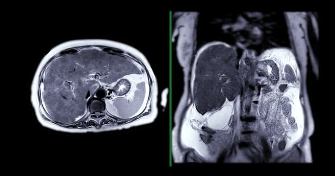 Magnetic resonance cholangiopancreatography or MRCP axial and coronal T2W view showing visualize the biliary and pancreatic ducts .