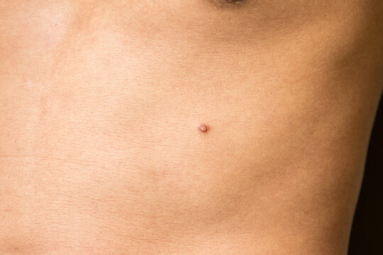Close up view part of body. A small brown tumor on the skin prominent on rib of men.