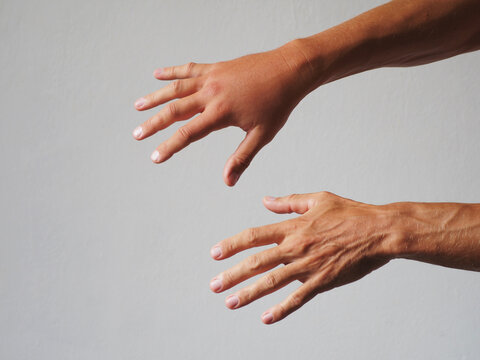 One Man's Hand Swollen. Close-up.