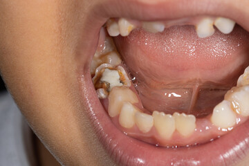 Destruction of a tooth by dental caries and disease