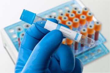 Blood sample tube for Monkeypox virus test. stranded DNA, zoonotic virus and a species of the genus Orthopoxvirus in the family Poxviridae
