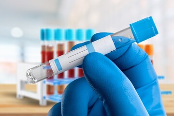 Blood sample tube for Monkeypox virus test. stranded DNA, zoonotic virus and a species of the genus Orthopoxvirus in the family Poxviridae