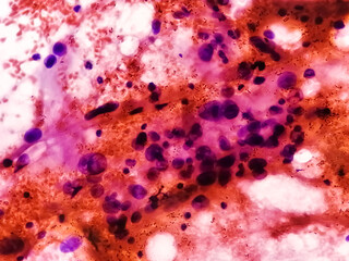 Spindle Cell Sarcoma: an extremely rare bone cancer. Photomicrograph of soft tissue tumor cytology.