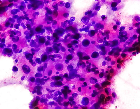 Spindle Cell Sarcoma: An Extremely Rare Bone Cancer. Photomicrograph Of Soft Tissue Tumor Cytology.