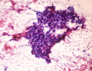 Intra abdominal mass(Cytology): Spindle cell sarcoma, positive malignant cells. Pleomorphic...