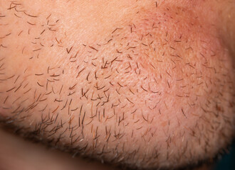 Hair on the skin of a man's face. Macro