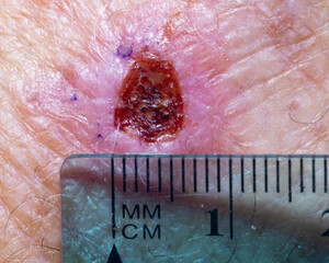 Incisional Biopsy Site on Male Hand
