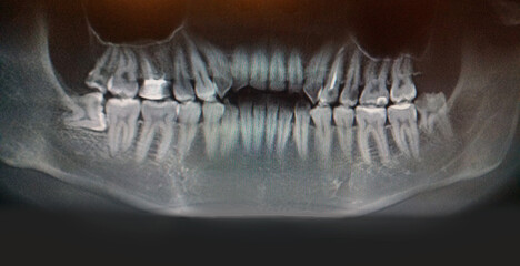 X-ray digital wisdom teeth. Panoramic dental x-ray. Dental x-ray tooth