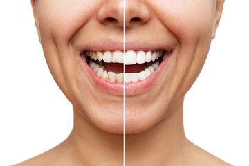 Cropped shot of a young caucasian smiling woman before and after veneers installation isolated on a...