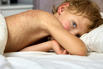 Sad look of a sick child covered in a red rash and lying on a bed under a blanket. A little boy is more rubella, lying in bed on his stomach - obrazy, fototapety, plakaty
