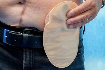 Senior with a stoma bag. Close-up of a colostomy bag